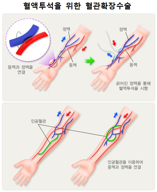 만성신부전, 투석방법 아는 것이 藥