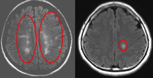 1990년대생 다발경화증 초기 환자의 뇌 자기공명영상(MRI, 왼쪽)을 보면 1970년대생 환자(오른쪽)에 비해 하얗게 변화된 뇌 염증이 초기부터 넓게 퍼져 있다. /사진제공=서울대병원
