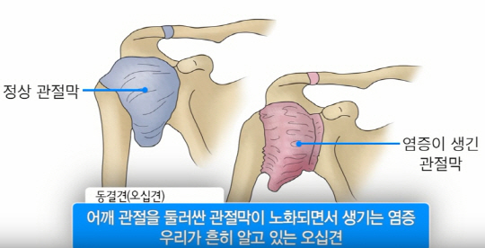 박근혜, 파열된 왼쪽 어깨·이두근 힘줄 봉합수술 받아