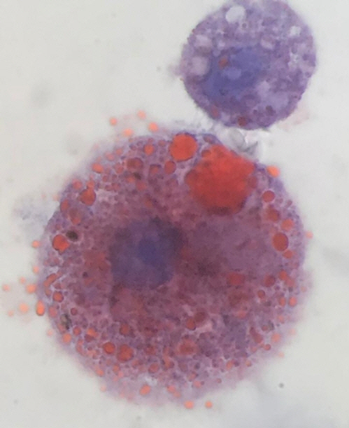 전자담배 관련 폐질환자의 폐에서는 미세 지질방울(붉은 점)이 잔뜩 포함된 대식세포들이 발견됐다. /사진제공=조든밸리메디컬센터