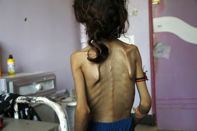 지난 12일(현지시간) 예멘 사나에 있는 알사빈 병원에서 영양 실조로 몸무게가 12㎏에 불과한 11세 소녀가 치료를 받기 위해 앉아 있다. 예멘은 지난 5년간의 내전으로 세계 최빈국으로 전락했다./사나=신화연합뉴스