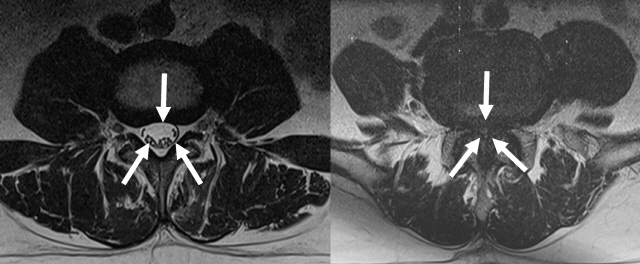 여유공간이 있고 척수가 희고 선명하게 보이는 정상적인 척추관(왼쪽 3개 화살표 안), 척수가 잘 보이지 않고 심하게 좁아져 있는 척추관협착증 환자의 척추관(오른쪽) 자기공명영상(MRI) 사진.