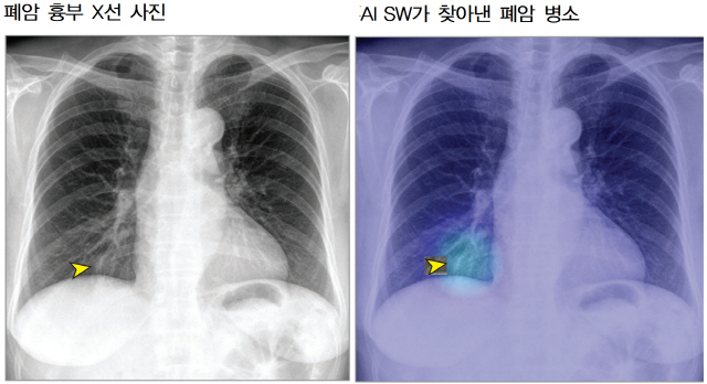 흉부 X선 사진(왼쪽)에서는 폐암 병소가 잘 안 보여 의사들이 첫 판독에서 찾아내지 못하는 경우가 많다. 반면 인공지능 소프트웨어(AI SW)는 폐암 병소(오른쪽 노란 화살촉 부분)를 특정해 보여준다. /사진제공=서울대병원