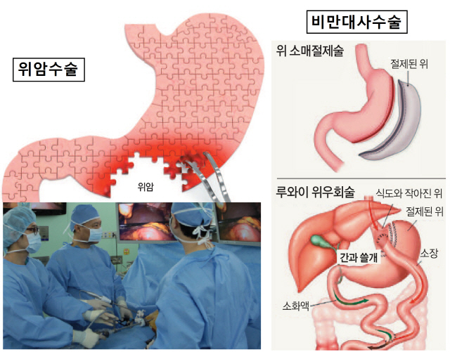 위 없는 것도 서러운데…알츠하이머 치매 위험 최고 2.7배