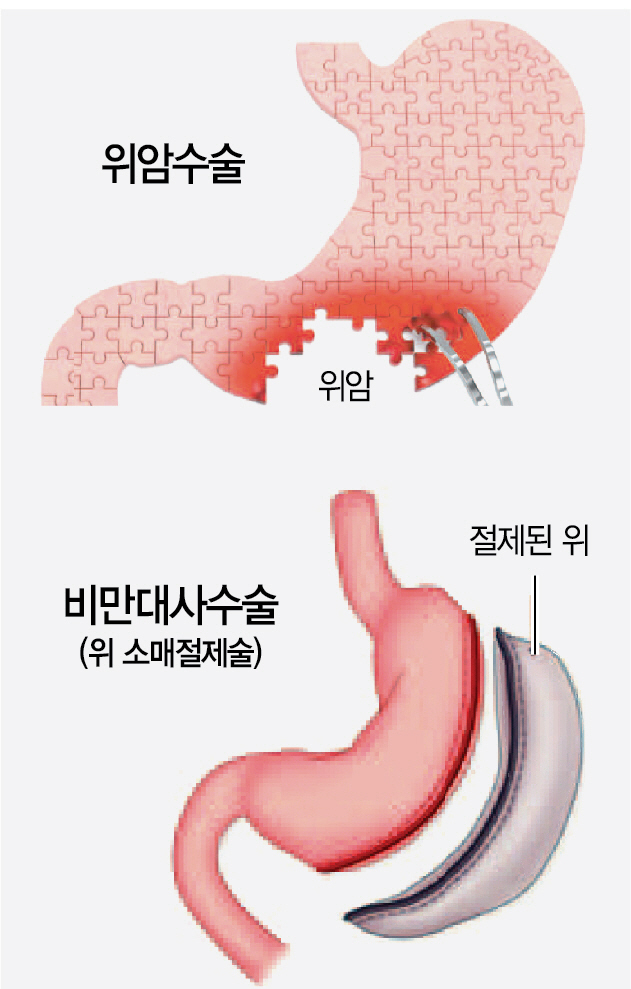 암·비만으로 위절제수술 받았다면...'비타민B12 보충하세요'