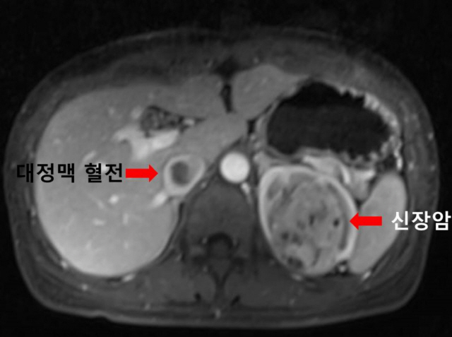 대정맥혈전을 동반한 신장암 여성의 컴퓨터단층촬영(CT) 사진
