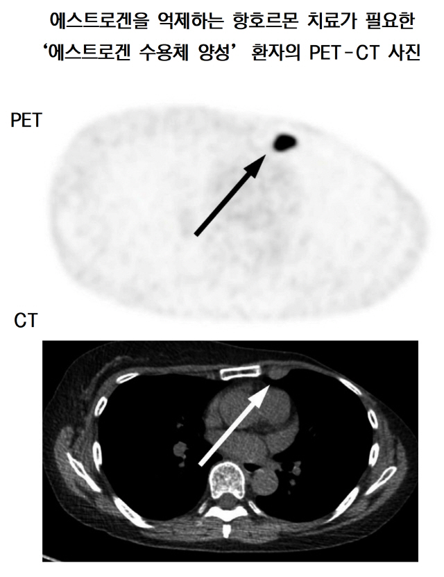 에스트로겐을 억제하는 항호르몬 치료가 필요한 ‘에스트로겐 수용체 양성’ 환자의 PET-CT 사진  PET, CT   여성호르몬인 에스트로겐이 암세포의 성장을 자극하는 ‘에스트로겐 수용체 양성’ 유방암 재발 환자의 18F 주사액 투여 후 양전자방출단층촬영(PET-CT) 영상. PET 영상(위)에서 까맣게 보이는 종양과 CT 영상(아래)에 찍힌 종양의 위치가 같아 에스트로겐 수용체 양성 종양임을 알 수 있다. 음성이면 CT·초음파 영상에서는 종양이 보이지만 PET 영상에서는 표시되지 않는다. /사진제공=서울아산병원 제공