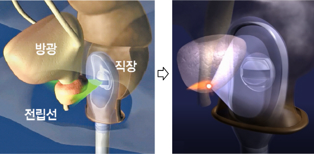 왼쪽은 ‘하이푸’(HIFU) 기기로 전립선 초음파 영상을 찍는 개념도. 초음파 영상은 자기공명영상(MRI)·조직검사 영상과 덧입혀진다. 오른쪽은 고강도 초음파를 전립선암 한 부위에 집중, 80도 이상의 열을 발생시켜 암을 파괴하는 하이푸 치료 모습. /사진=EDAP-TMS사