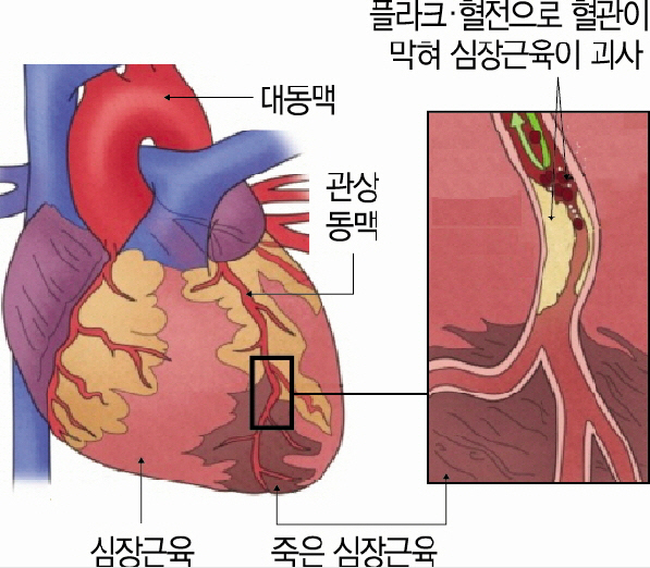 심근경색 환자 심장보호제 효과 심박수 따라 큰 差 서울경제 3595