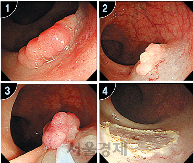 대장내시경으로 선종을 제거하는 과정. /사진제공=서울아산병원
