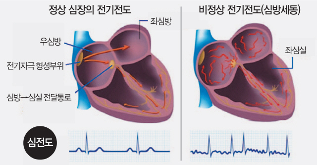 건강 팁 심장이 너무 빨리·천천히 뛰는 부정맥두근거림·어지러움·실신 등 유발 서울경제 7547