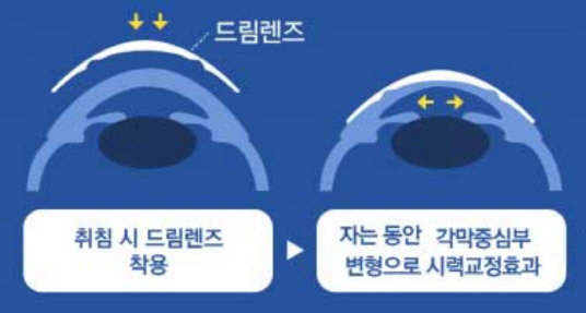 근시 진행을 늦추는 ‘드림렌즈’의 원리. /그림제공=누네안과병원