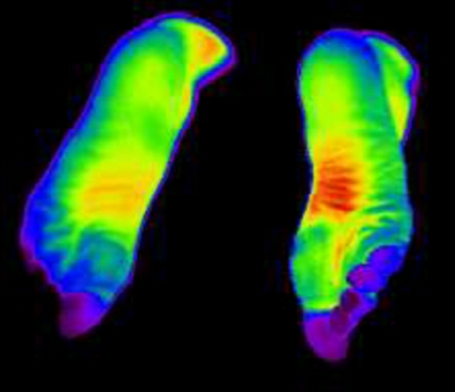 수족냉증 환자의 발을 적외선으로 촬영한 모습. 발끝(보라색)의 온도가 다른 부위에 비해 현저하게 낮다. /사진제공=자생한방병원