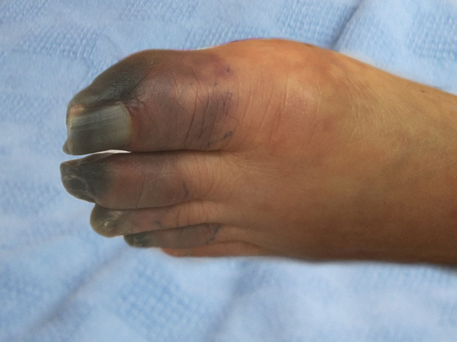 말초혈관이 막혀 손·발가락 괴사까지 초래하는 버거씨병 환자의 발. /사진제공=분당서울대병원