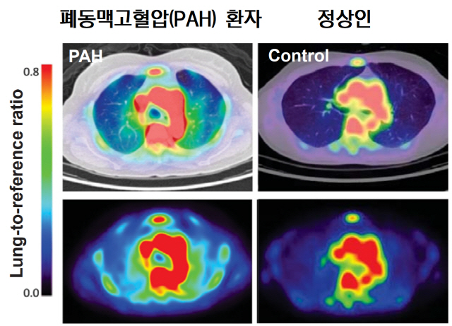 폐동맥고혈압(PAH) 환자와 정상인의 폐 양전자단층촬영(PET)/컴퓨터단층촬영(CT) 사진. 염증반응이 있는 환자의 폐혈관, 특히 중앙 부분이 정상인의 것보다 선명한 색깔로 나타난다. /사진제공=서울대병원