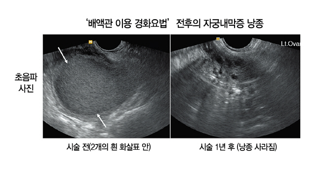 배액관 자궁내막증 초음파