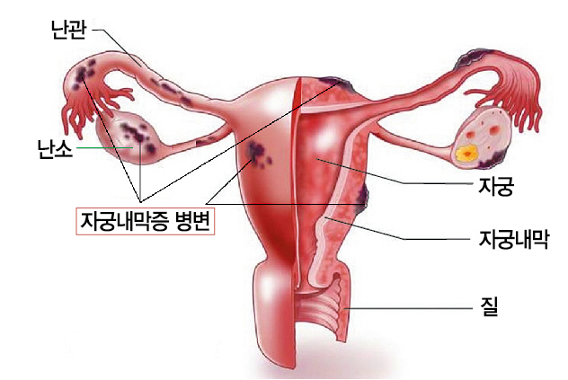 '3㎝ 넘는 난소 낭종 치료에 '배액관 경화요법' 효과적'