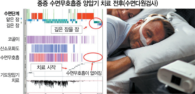 수면무호흡증을 치료하지 않으면 면역력이 떨어지는 것은 물론 뇌경색·심혈관질환·치매·돌연사 위험을 높인다. 기본적인 치료방법은 기도 양압기 치료다.