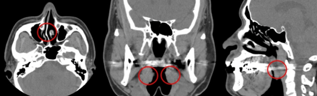 코골이 원인인 비중격만곡증(왼쪽부터), 편도 비대, 늘어진 목젖을 찍은 CT컴퓨터단층촬영) 영상.
