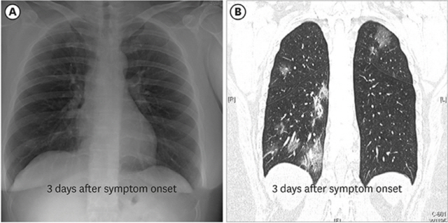 증상 발생 3일째에 찍은 코로나19 1번 환자의 흉부X선 사진(왼쪽)에는 폐 침윤이 보이지 않는다. 반면 같은 날 찍은 고해상도 컴퓨터단층촬영(HRCT) 영상에서는 양쪽 폐 여러 곳에 안개가 낀 듯한 침윤이 관찰됐다.