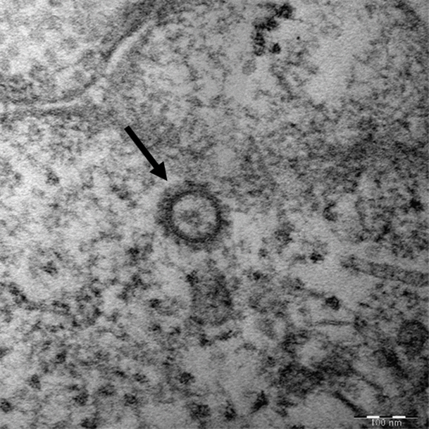 신종 코로나바이러스의 전자현미경 사진./사진=질병관리본부