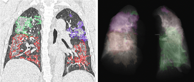 폐 실질 영역의 19.8%가 폐렴 병변을 보이고 있는 55세 코로나19 환자의 컴퓨터단층촬영(CT) 영상을 3차원(3D)으로 재구성한 이미지. 폐렴 병변 부위를 위치에 따라 빨강·보라·녹색 등 여러 색깔로 표시했다. X선 사진에선 병변이 안개가 낀 것처럼 보인다.