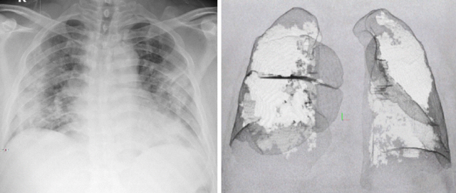 3차원 CT 영상을 X선 사진과 같은 2차원으로 전환한 이미지(왼쪽). 안개가 낀 것처럼 보이는 것이 폐렴 병변으로 3차원 CT 영상에서 확인할 수 있는 폐렴 병변의 56%까지 확인할 수 있다. 오른쪽은 폐렴 병변의 모양을 예상한 이미지.