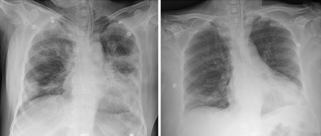 코로나19 환자인 67세 여성에게 입원 6일차에 완치자의 회복기 혈장을 주입하기 전후(왼쪽 2일차, 오른쪽 6일차)에 찍은 흉부X선 사진. 6일차 사진에서는 양측 폐 침윤이 현저하게 개선됐다.