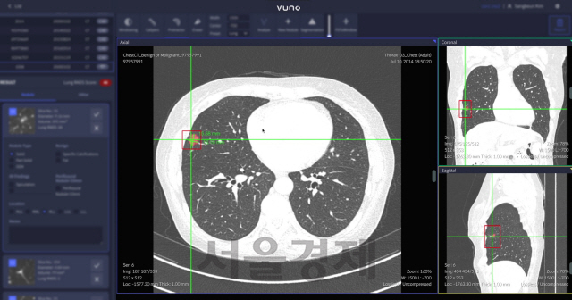 뷰노메드 흉부 CT AI 스크린샷/사진제공=뷰노