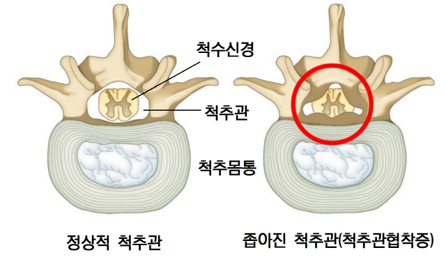 정상적 척추관, 좁아진 척추관(척추관협착증), 척수신경, 척추 몸통, 척추관