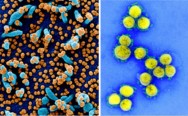 왼쪽은 코로나19 환자에서 분리된 바이러스(왼쪽 오렌지색)로 심하게 감염된 세포(파란색)를 주사 전자현미경으로 찍은 사진. 오른쪽은 바이러스(노란색)를 투과 전자현미경으로 찍은 사진. /출처=미국 국립알레르기·전염병연구소(NIAID)