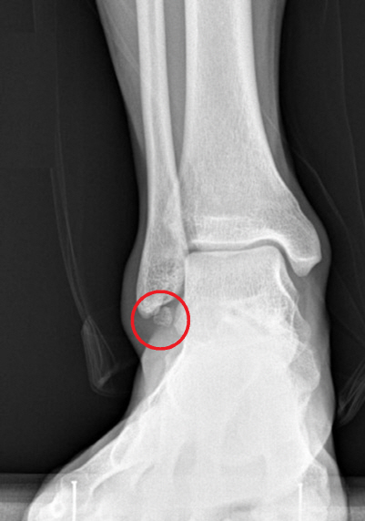 만성 발목 불안정증 성인 30~40%의 종아리뼈 아래에서 발견되는 뼛조각(빨간 원). 통증·부종·불편감과 불안정증 심화를 초래한다.