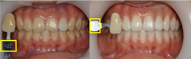 치아 미백술, 주기적 재치료 필요... 흡연·커피는 자제를