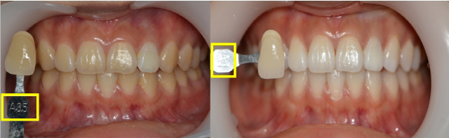 치아미백술을 받기 전(왼쪽)과 후(오른쪽). 치아 색상이 A3.5에서 A1으로 좀더 희고 밝아졌다. /사진제공=서울대치과병원