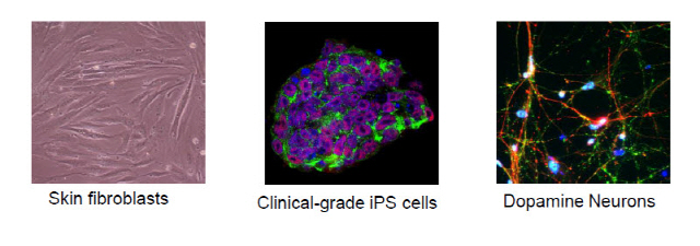 김광수 교수팀이 맞춤형 줄기세포를 적용한 파킨슨병 환자의 임상시험 결과. 환자의 체세포(왼쪽)를 줄기세포(가운데) 상태로 되돌린 뒤 다시 도파민 분비 신경세포(오른쪽)로 분화시켜 환자의 뇌에 이식했다.  /자료제공=KAIST
