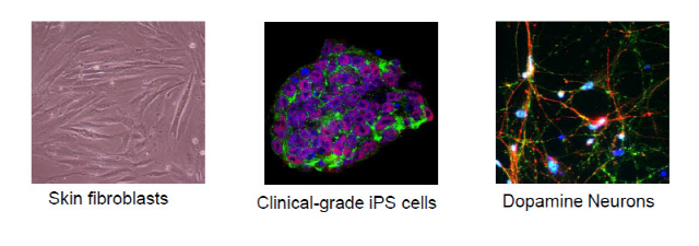파킨슨병 임상치료 성공...'만능줄기세포'로 해냈다