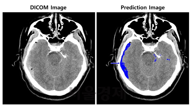 SK C&C가 개발한 ‘뇌출혈 영상 판독 AI 모델’이 뇌출혈이 의심되는 환자의 뇌 CT 영상(왼쪽)에서 출혈 병변의 위치(오른쪽)를 식별하고 있다./사진제공=SK C&C