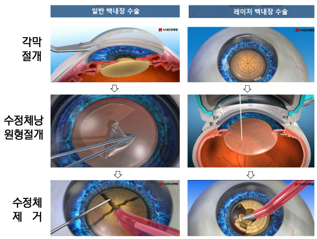 (누네안과병원 제공)