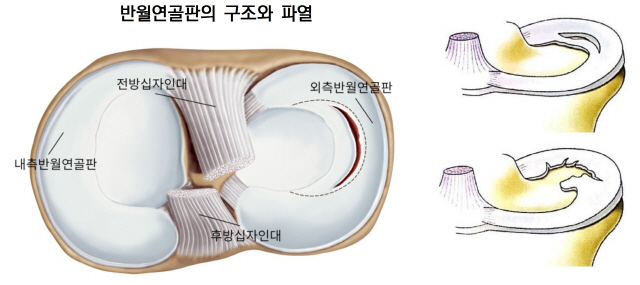 운동 후 무릎 통증·기능이상, 3~4주 이상 지속 땐 정밀검사를