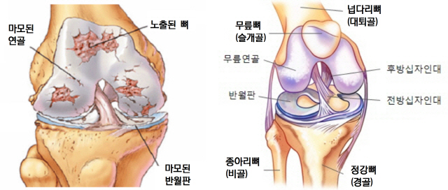 운동후 무릎통증 3~4주 이상 지속땐 연골·인대손상 의심을