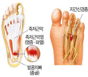 굽 없는 샌들·하이힐·볼 좁은 신…발바닥·발가락 곡소리 난다