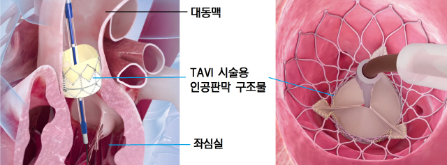 대동맥판막 교체, 가슴 절개 않는 TAVI 시술 는다