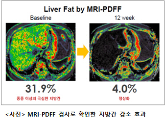 MRI-PDFF 검사로 확인한 랩스트리플아고니스트의 지방간 감소 효과/사진제공=한미약품
