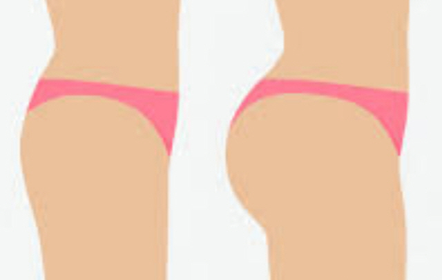 미국 등에서는 개미 허리에 엉덩이를 키우고 올려서 빵빵하게 만들어 과장된 굴곡의 여성미를 강조하는 BBL(Brazilian butt lift) 수술이 유행하고 있다.