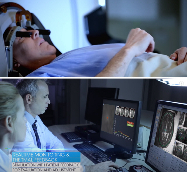 인사이텍의 ‘엑시블레이트 뉴로’는 자기공명영상(MRI)을 활용해 고집적 초음파 치료 뇌 부위를 실시간으로 모니터링하기 때문에 오차 범위를 1㎜ 이내에 불과하다. /출처=인사이텍 홈페이지