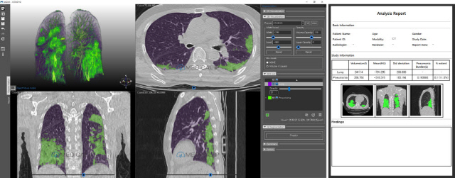 메디컬아이피의 ‘메딥 코비드19’ 프로그램을 이용하면 CT 영상을 통해 폐 조직 내부의 코로나19 부위 분석·진단이 가능하다. /사진제공=메디컬아이피