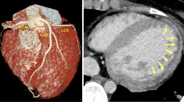 심장 컴퓨터단층촬영(CT) 이미지는 심장근육에 혈액을 공급하는 관상동맥이 막히지 않고 정상(왼쪽)임을 보여주지만 좌심실(오른쪽 노란 화살표 부분) 등 심장의 크기는 심근 염증·부종으로 비대해져 있다. /사진=유럽심장학회지