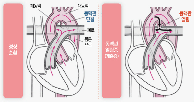 1015A26 동맥관