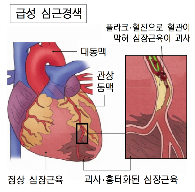 심근경색 '스텐트+세포치료' 심부전·사망 위험 1/2로↓