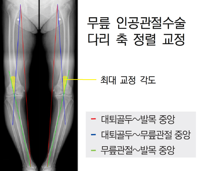정교한 로봇 무릎 인공관절수술, 인대 손상·통증 감소